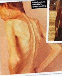 Болезнено слаби жени, страдащи от напреднал стадий на анорексия