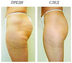 КАВИТАЦИЯ – НОВОТО ЧУДО НА МЕДИЦИНАТА